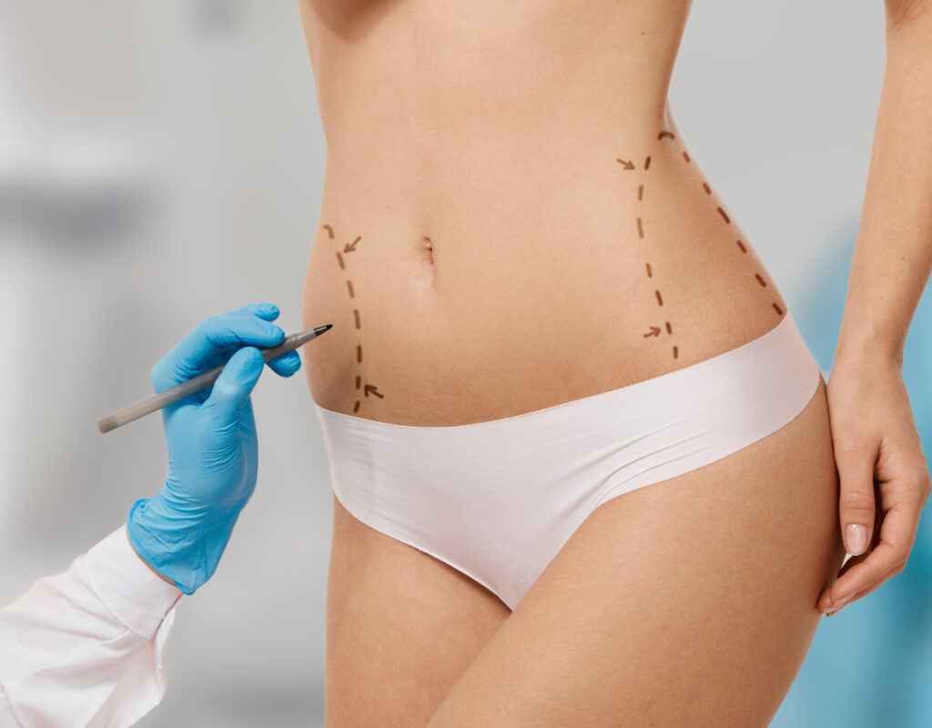 Capital Care Abdominoplasty Procedure Block 1