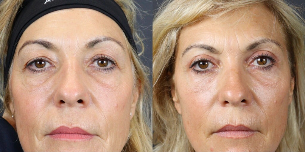 Capital Care Prestation Blepharoplastie Avant Apres 1