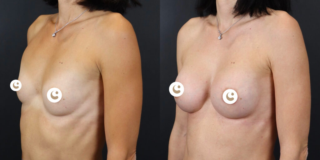 Breast augmentation with implants