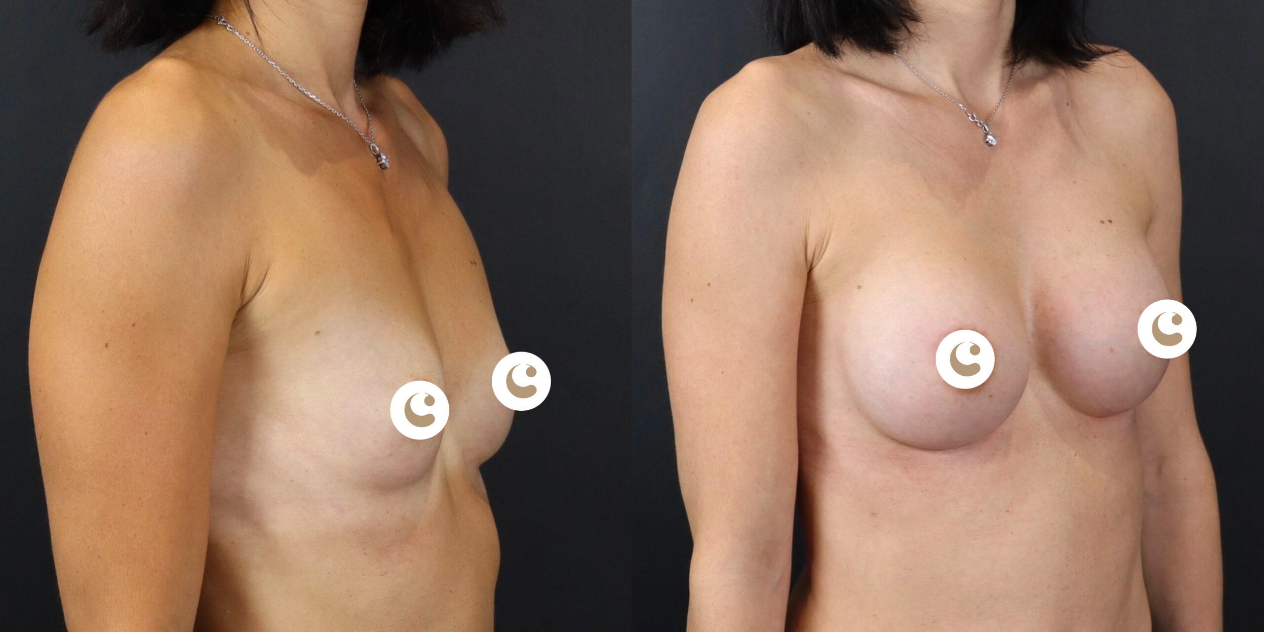 Breast augmentation with implants