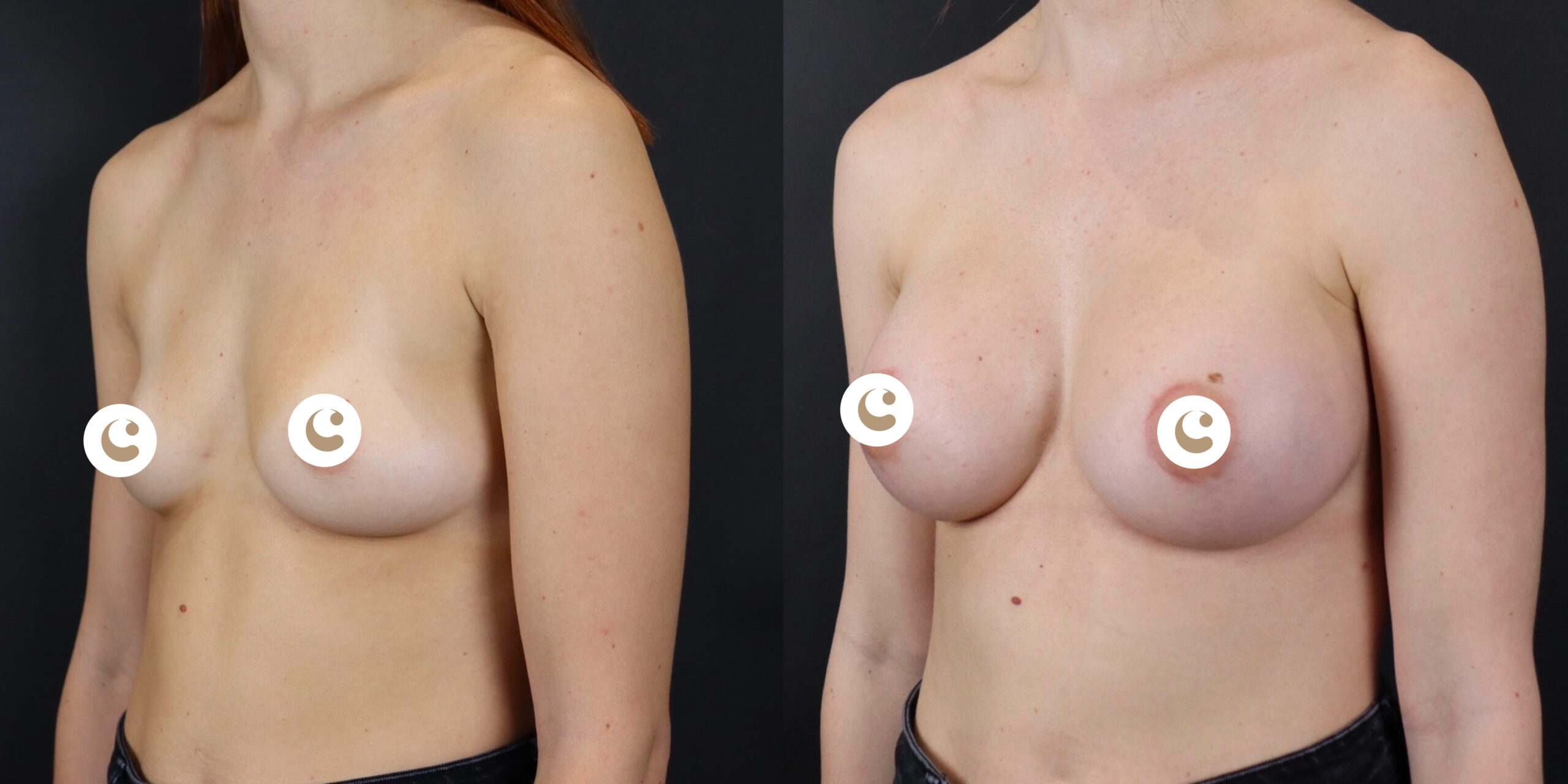 Breast augmentation and lipofilling in Geneva