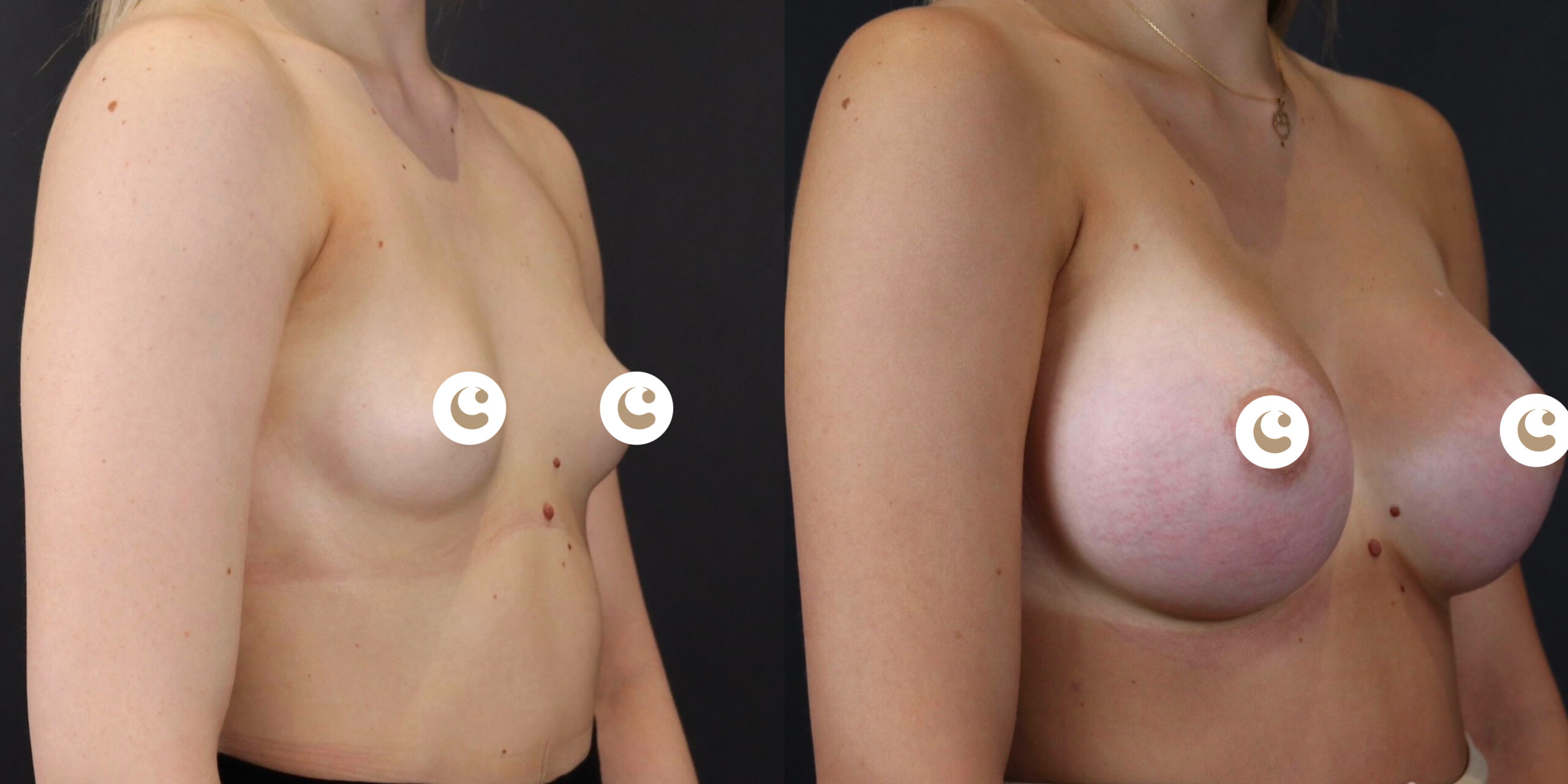 Breast augmentation in Geneva