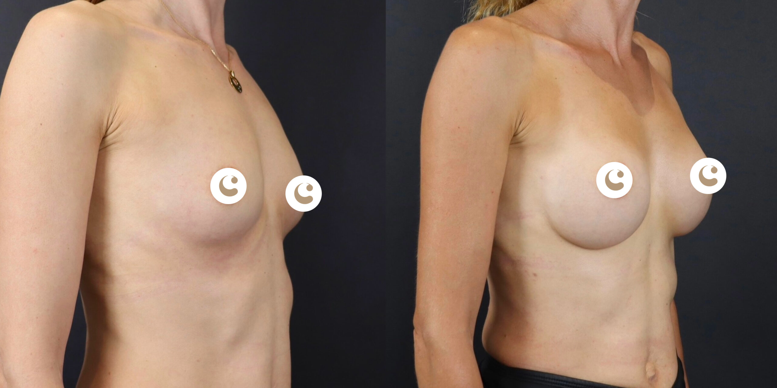 Breast augmentation patients with implants